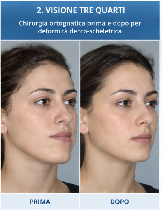 Chirurgia ortognatica prima e dopo in visione tre quarti per deformità dento-scheletrica