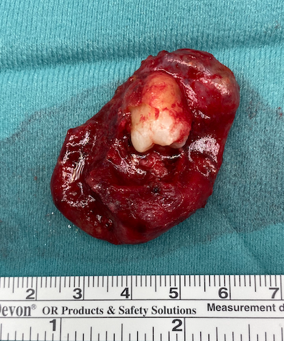 Pezzo operatorio di neoformazione odontogena associata a un dente incluso