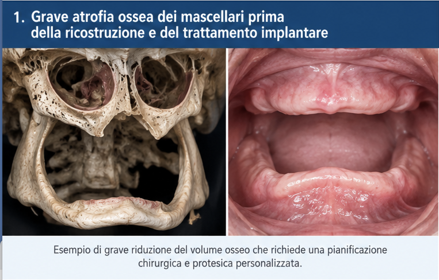 Grave atrofia ossea dei mascellari prima della ricostruzione e del trattamento implantare