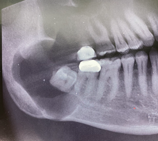 Neoformazione osteolitica della mandibola associata a un dente del giudizio incluso