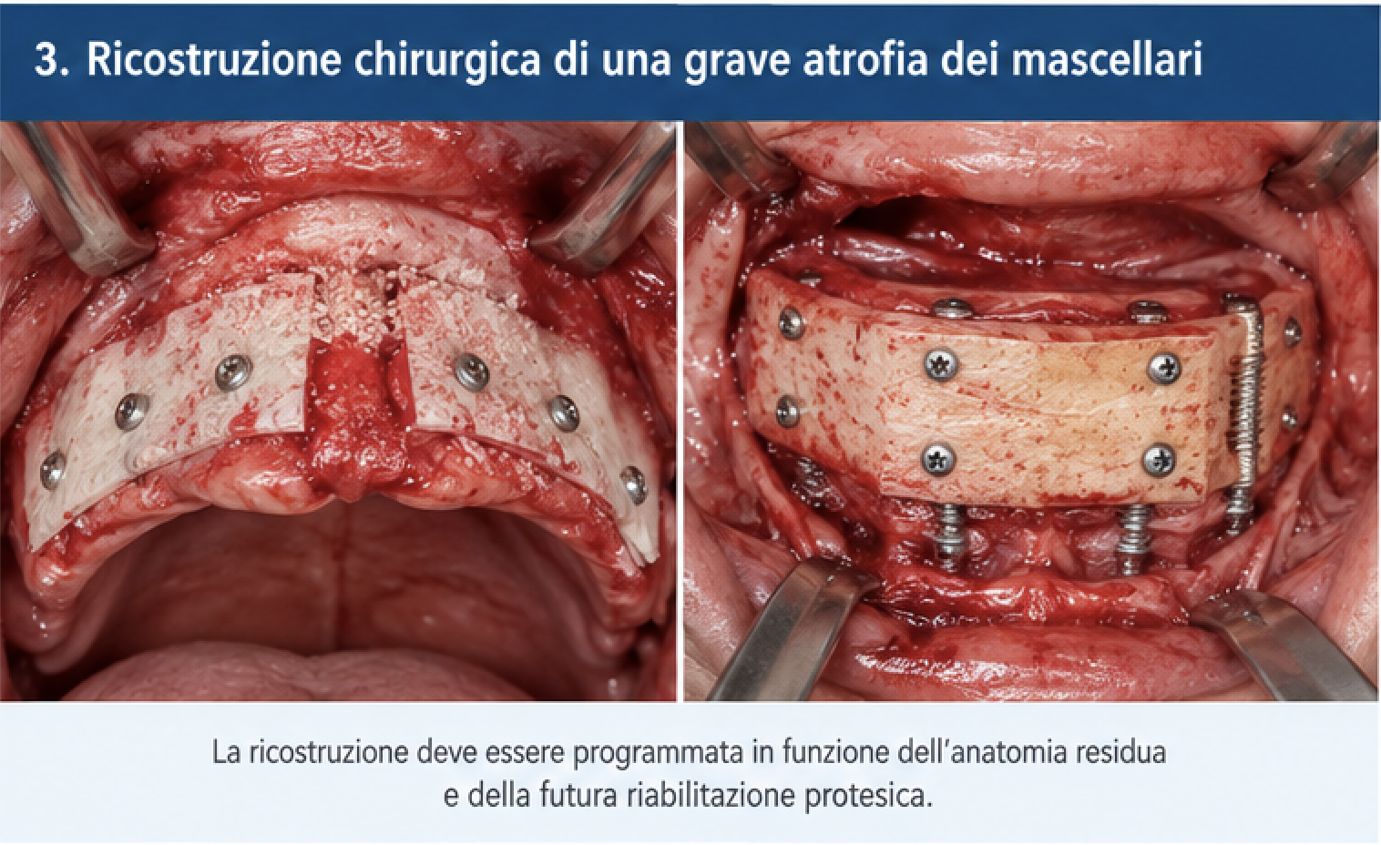 Ricostruzione chirurgica di una grave atrofia dei mascellari