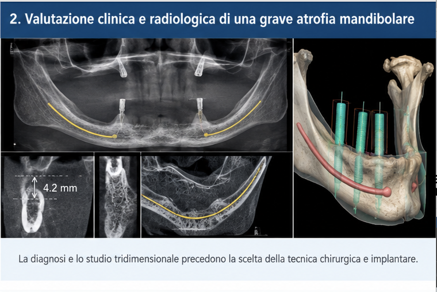 Valutazione clinica e radiologica di una grave atrofia mandibolare